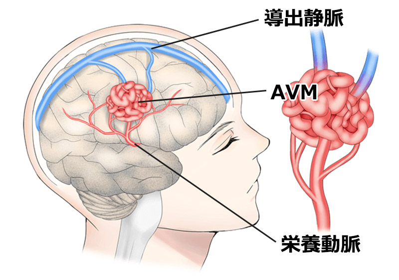 AVM（脳動静脈奇形）