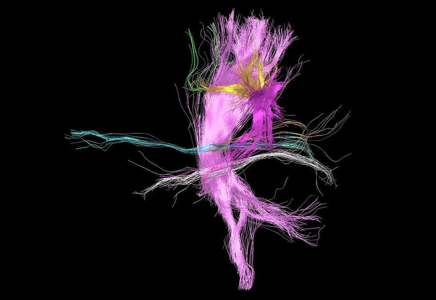 tractography