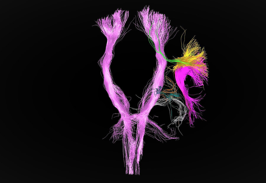 tractography