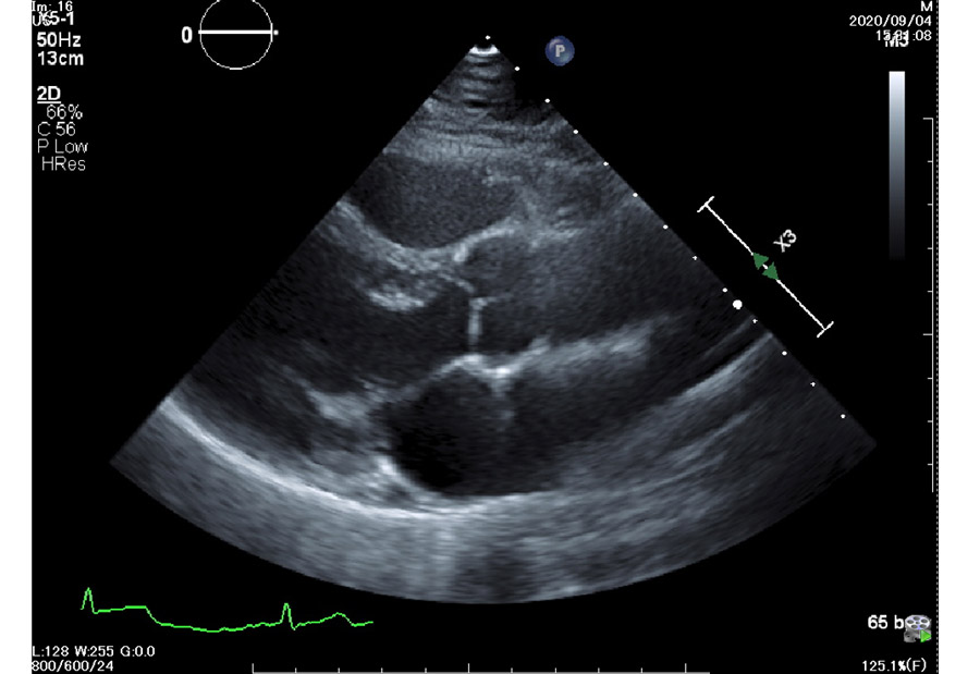 エコー画像２