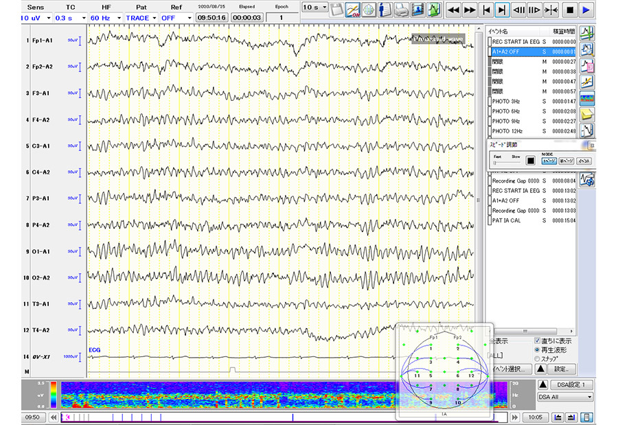 EEG検査結果