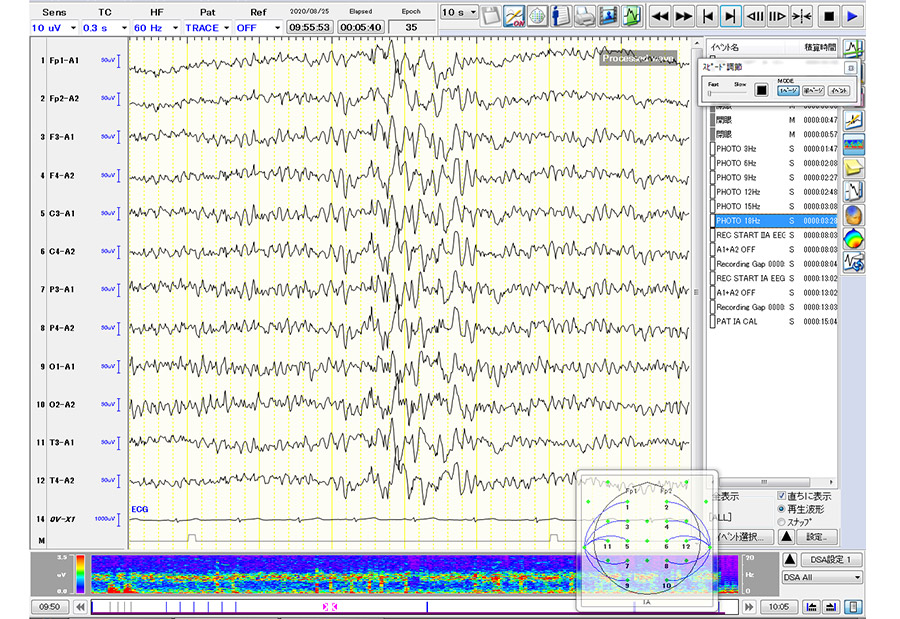 EEG検査結果