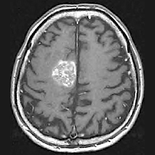 右前頭葉の転移性脳腫瘍症例 治療時