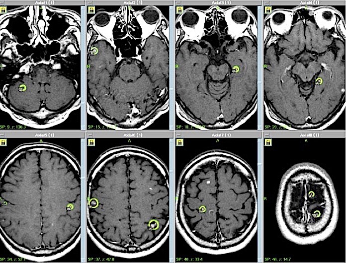 転移性脳腫瘍（1１カ所の腫瘍）の線量計画