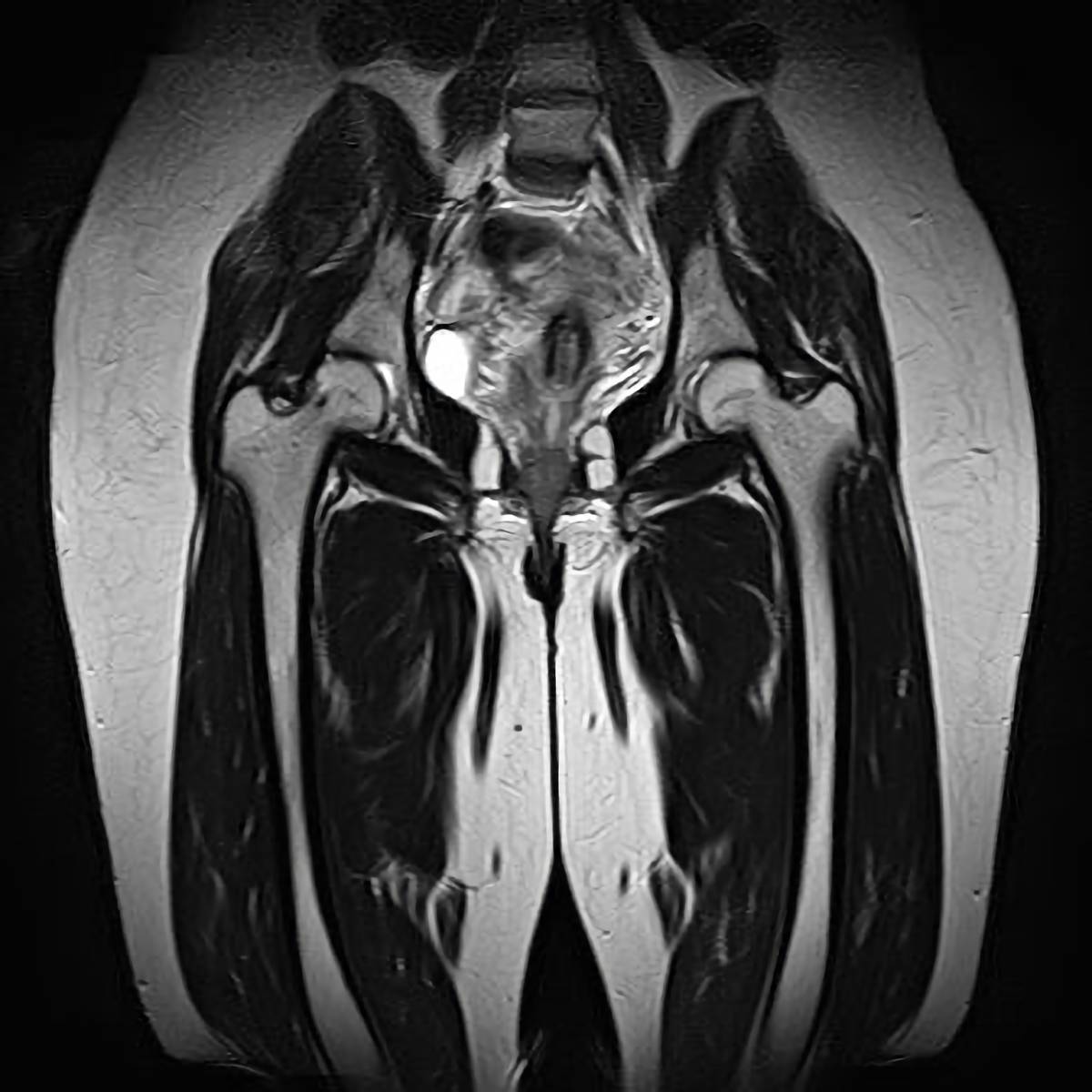 股関節 mri で わかる こと