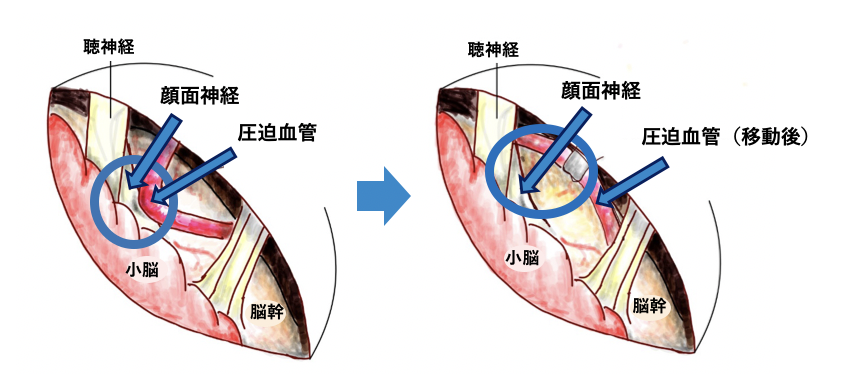 手術治療（神経血管減圧術：MVD）