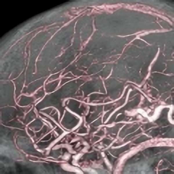 手術前（脳血管撮影画像）1