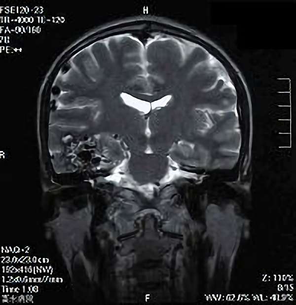 手術前（脳血管撮影画像）6
