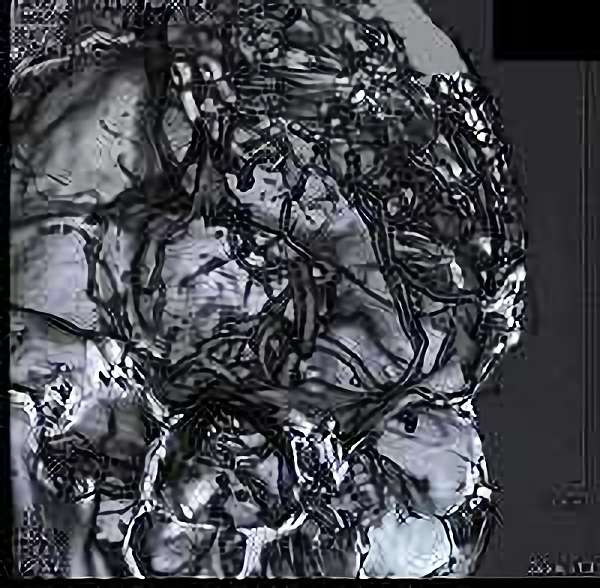 手術前（脳血管撮影画像）5
