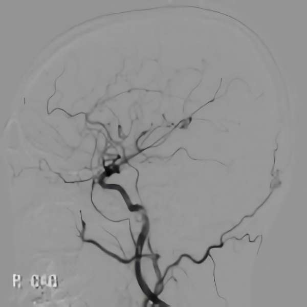 手術前（脳血管撮影画像）2