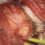 No.’26_25　摘出 前