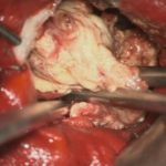 No.’26_25　 摘出 中