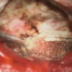 No.’26_25　摘出 後