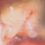 No.’26_26　摘出 前