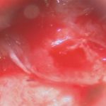 No.’26_26　 摘出 中