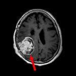 No.’25_83　手術前1