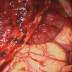 No.’25_83　摘出 前