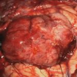 No.’25_83　 摘出 中