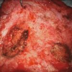 No.’25_83　摘出 後