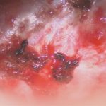 No.’26_4　摘出 前