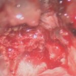 No.’26_4　 摘出 中