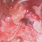 No.’26_4　摘出 後