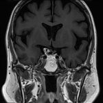 No.’25_113　手術前2
