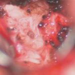 No.’25_113　摘出 前