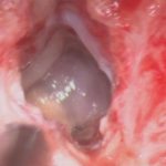 No.’25_113　 摘出 中