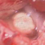 No.’25_113　摘出 後