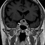 No.’25_107　手術前2