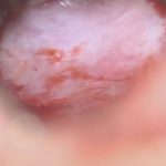 No.’25_107　摘出 前