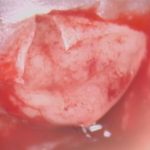 No.’25_107　 摘出 中