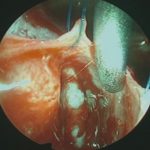 No.’25_107　摘出 後