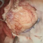 No.’26_24　摘出 前