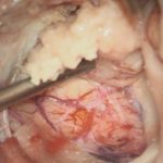 No.’26_24　 摘出 中