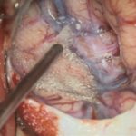 No.’26_24　摘出 後