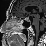 No.’26_11　手術前2