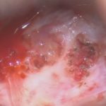 No.’26_11　摘出 前