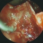 No.’26_11　 摘出 中