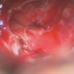 No.’26_11　摘出 後