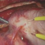 No.’26_13　 摘出 中