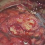 No.’26_13　摘出 後