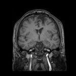 No.’25_91　手術前1