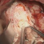 No.’25_91　摘出 前