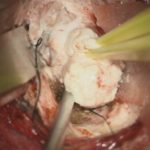 No.’25_91　 摘出 中