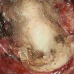 No.’25_91　摘出 後