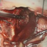 No.’26_1　摘出 前