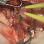 No.’26_1　 摘出 中