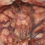 No.’26_1　摘出 後